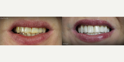 Smile Makeover before and after photo
