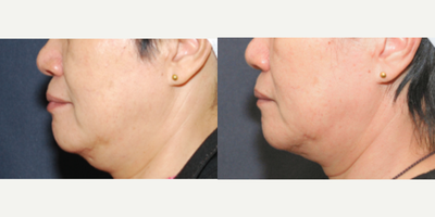 Ultherapy before and after photo