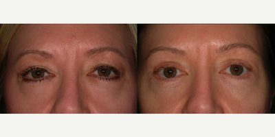 Eyelid Surgery before and after photo