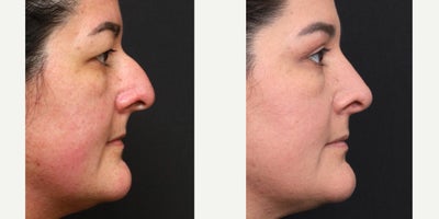 Eyelid Surgery before and after photo