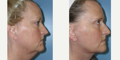 Facelift before and after photo