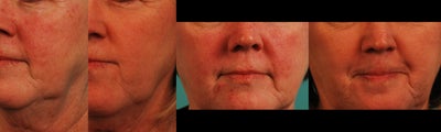 Laser Genesis before and after photo