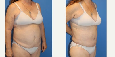 Liposuction before and after photo