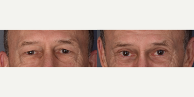 Eyelid Surgery before and after photo