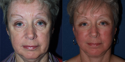 Facelift before and after photo
