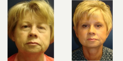 Facelift before and after photo