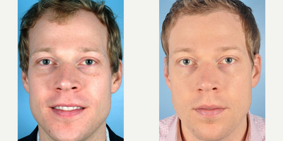 Hair Transplant before and after photo