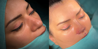 Rhinoplasty before and after photo