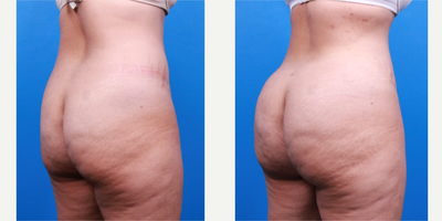 Brazilian Butt Lift before and after photo