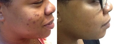 Chemical Peel before and after photo