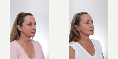Facial Fat Transfer before and after photo