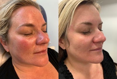 Lumecca before and after photo