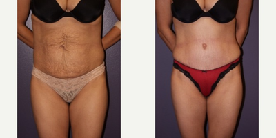 Tummy Tuck before and after photo