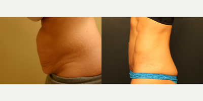 Tummy Tuck before and after photo
