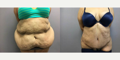 Tummy Tuck before and after photo