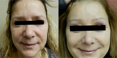 Brow Lift before and after photo