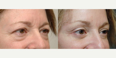 Eyelid Surgery before and after photo