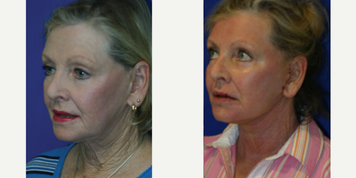 Facelift before and after photo