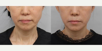 Facelift before and after photo