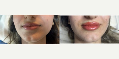 Juvederm before and after photo