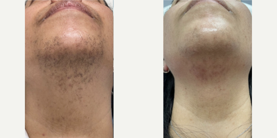 Laser Hair Removal before and after photo