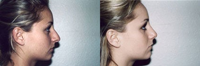 Rhinoplasty before and after photo