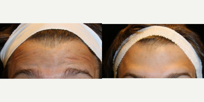 Botox before and after photo