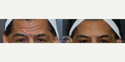 Botox before and after photo