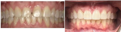 Invisalign before and after photo