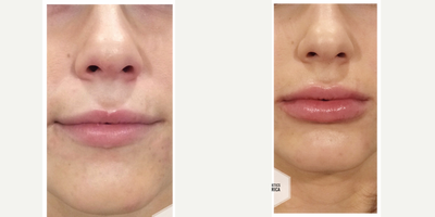 Juvederm before and after photo
