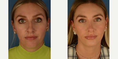 Rhinoplasty before and after photo