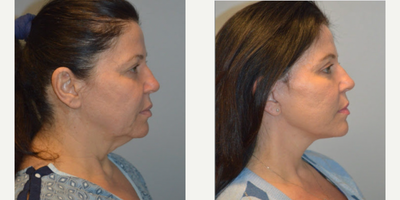CO2 Laser before and after photo