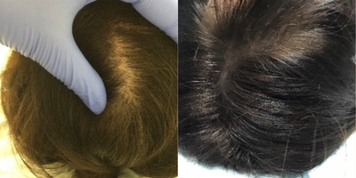 Hair Loss Treatment before and after photo