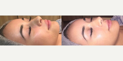 Dermaplaning before and after photo