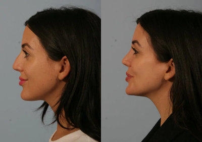 Rhinoplasty before and after photo