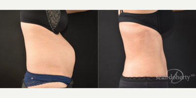 Tummy Tuck before and after photo