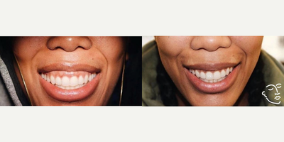 Botox before and after photo