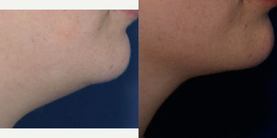 Chin Liposuction before and after photo