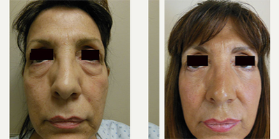 Eyelid Surgery before and after photo