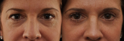 Eyelid Surgery before and after photo