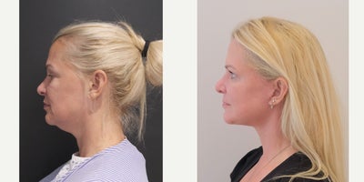 Facelift before and after photo
