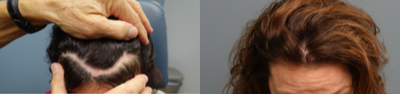Hair Transplant before and after photo