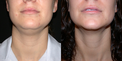Liposuction before and after photo