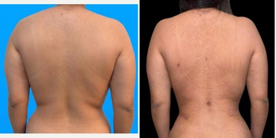 Liposuction before and after photo