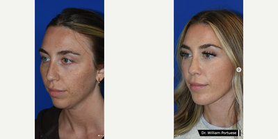 Neck Lift before and after photo