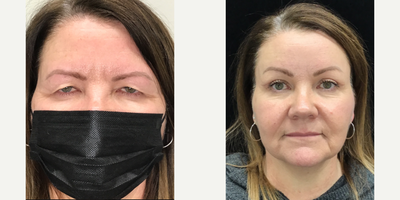 Brow Lift before and after photo