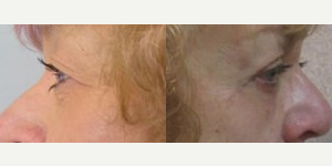 Eyelid Surgery before and after photo