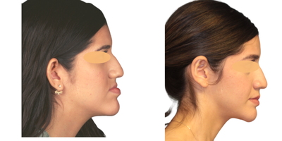 Jaw Surgery before and after photo