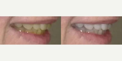 Smile Makeover before and after photo