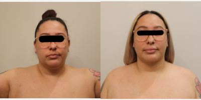 Chin Liposuction before and after photo